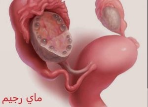 علاج تكيس المبايض